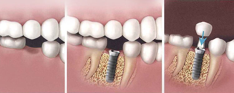 bursa implant fiyat